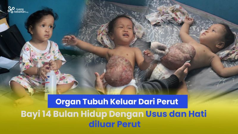 Usus dan Hati berada diluar Perut Bayi Hana harus segera Operasi